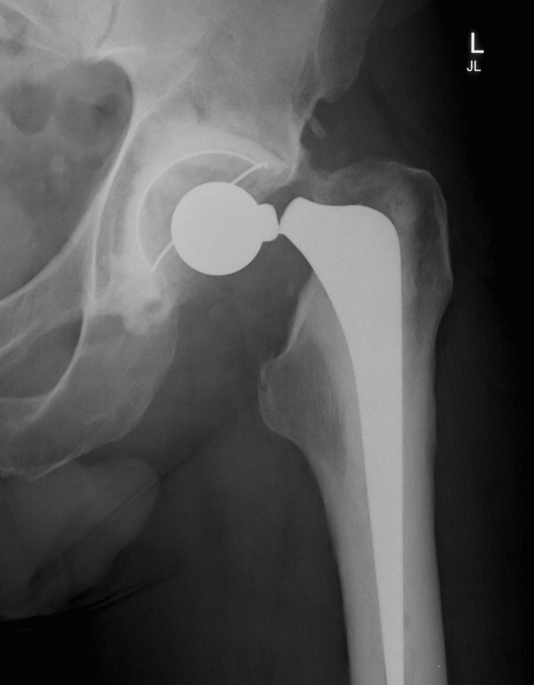 THR Exeter Stem Fracture